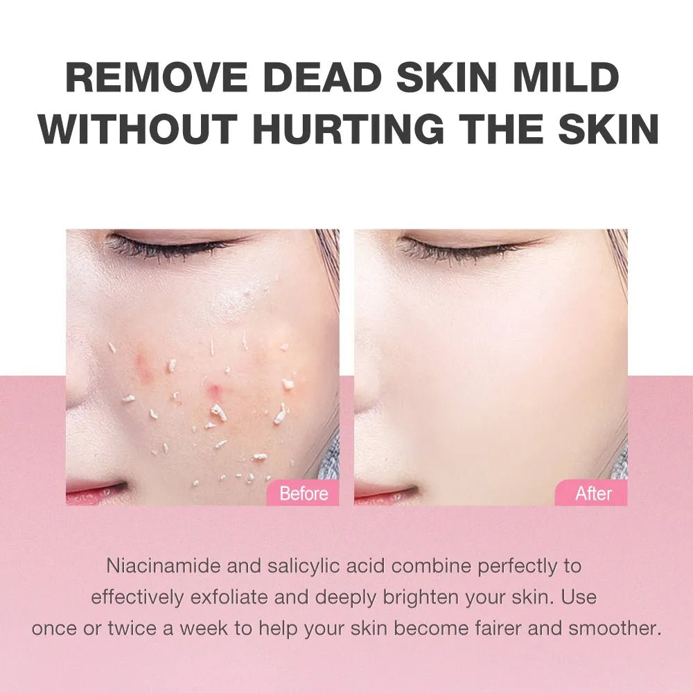 Before and after skin comparison showing acne and dead skin removal on a woman's cheek, with text stating 'REMOVE DEAD SKIN MILD WITHOUT HURTING THE SKIN' and product benefits for niacinamide and salicylic acid.