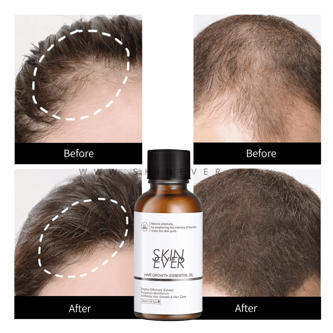 SKIN EVER Hair Growth Essential Oil – Skin Ever